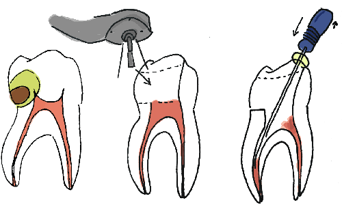 Imagen de una caries, susceptible de resolverse mediante endoconcia. La endodoncia es uno de los muchos tratamientos que se realizan en la clínica dental Clínica Herrero en Valencia.